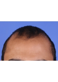 Before Hair Transplant&nbsp;2 Sessions (Areas)